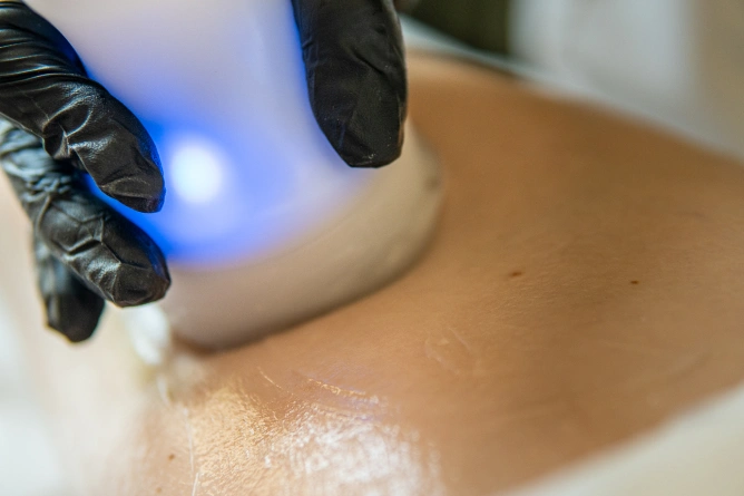 Zbliżenie dłoni w rękawiczce trzymającej urządzenie emitujące niebieskie światło, przyłożone do nagiej skóry osoby podczas zabiegu medycyny estetycznej Wrocław.