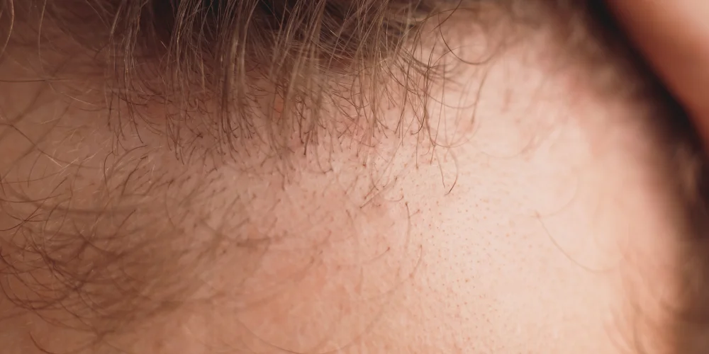 Close-up of a person’s scalp and hairline, showing fine, thin hair and visible skin on the forehead at a klinika medycyny estetycznej.
