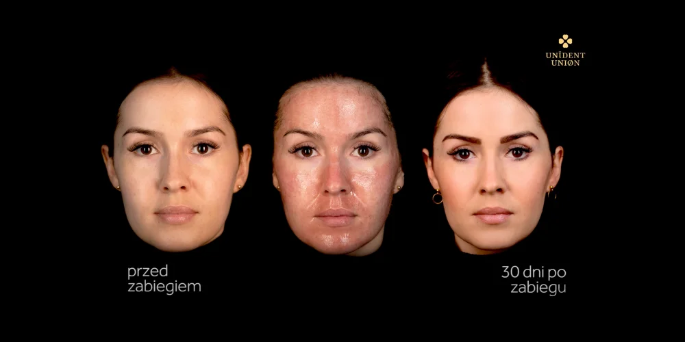 Three side-by-side photos show a woman's face: before a procedure at a klinika medycyny estetycznej, during with shiny skin, and after 30 days with smoother skin. Polish text reads przed zabiegiem and 30 dni po zabiegu.
