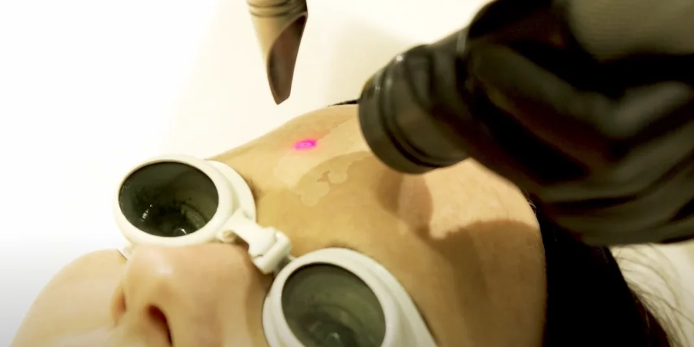 A person wearing protective goggles receives a laser treatment on their face at a klinika medycyny estetycznej; a gloved hand holds the laser device emitting a small pink light on the skin.
