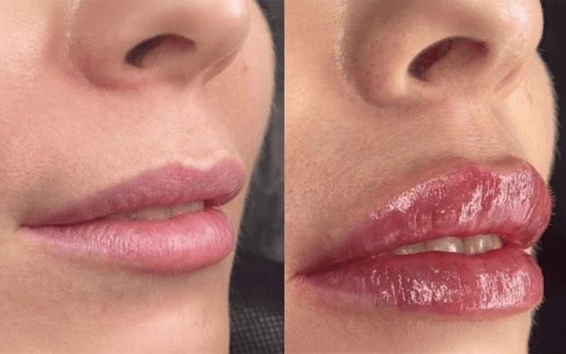 Side-by-side comparison of lips before and after powiększanie ust Wrocław; the left shows natural, matte lips, while the right displays fuller, glossy, and more defined lips with enhanced color from medycyna estetyczna Wrocław.