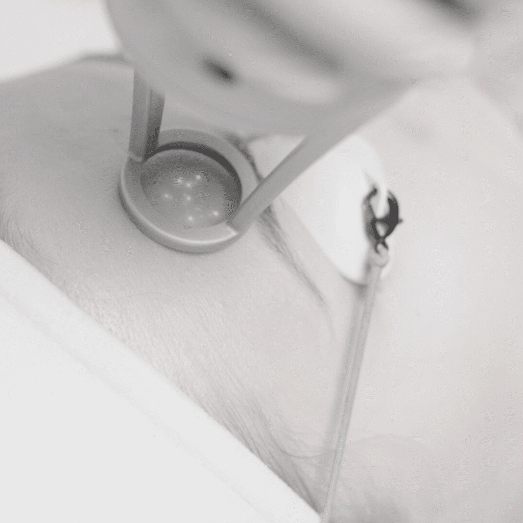 A close-up of a person undergoing a laser skin treatment on their face at a klinika medycyny estetycznej. The individual wears protective eye gear as a device emits light, creating a clinical and sterile atmosphere.