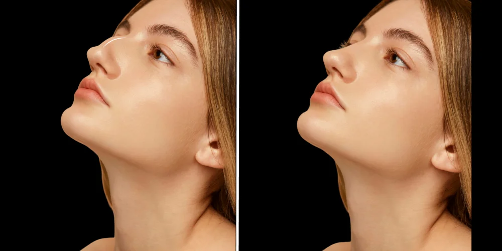 Niechirurgiczna korekta nosa kwasem hialuronowym