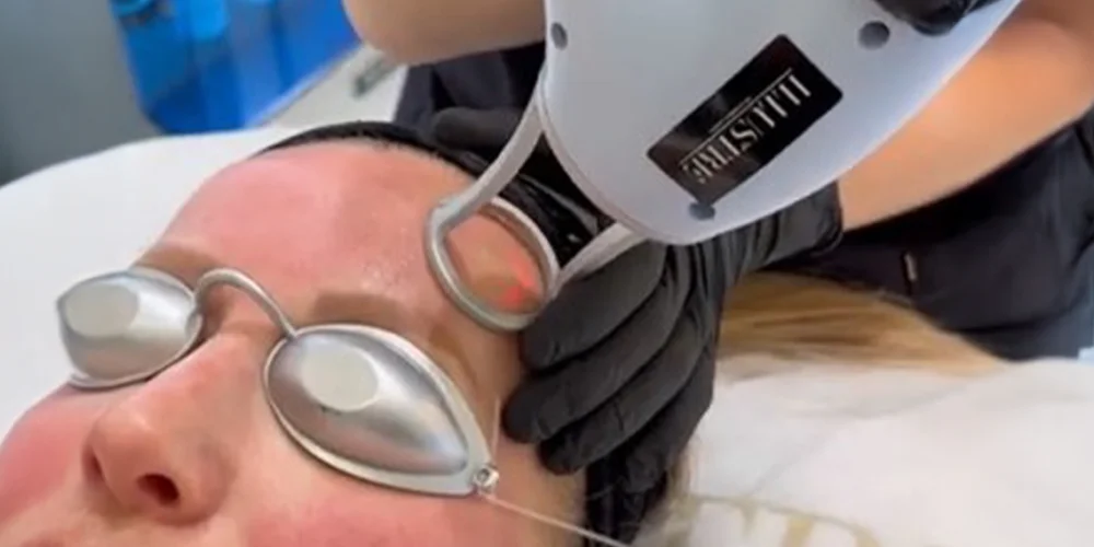 A person wearing protective goggles receives a laser facial treatment from a technician using a handheld device, while lying down in a klinika medycyny estetycznej.
