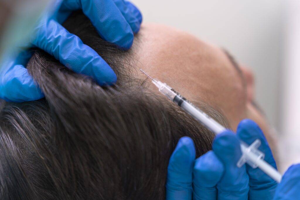 A close-up of a person receiving an injection in the scalp at a klinika medycyny estetycznej, with gloved hands administering the treatment—showcasing a medical or cosmetic procedure for hair or skin.