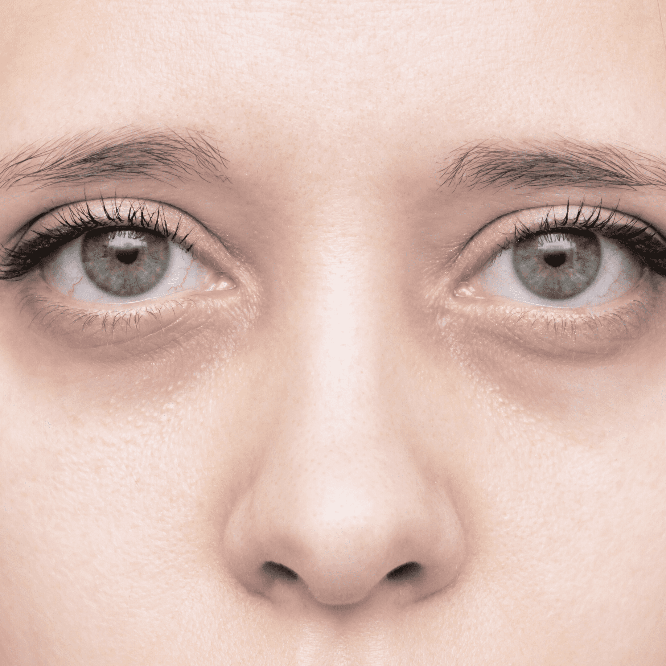 A close-up of a person’s face showing both eyes, nose, and part of the eyebrows at a klinika medycyny estetycznej. The skin is fair, the eyes are light-colored, and there are visible dark circles under the eyes.