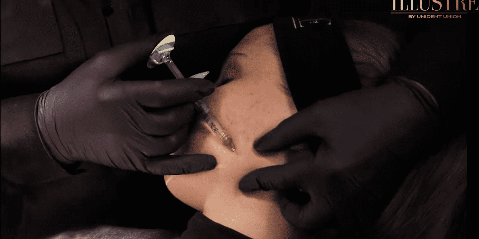 Modelowanie brody, linii żuchwy i kąta żuchwy kwasem hialuronowym