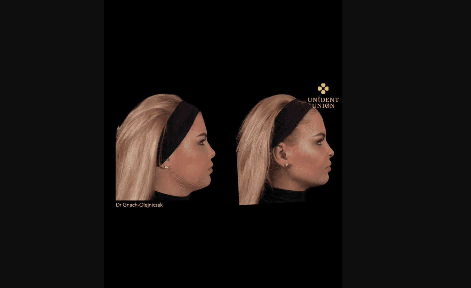 Modelowanie twarzy kwasem hialuronowym – wyszczuplenie twarzy